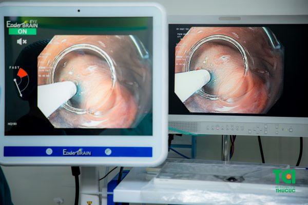 Hình ảnh nội soi phóng đại