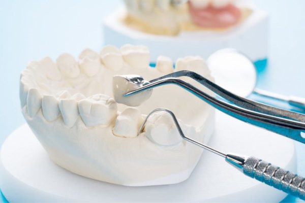 Bọc sứ khắc phục tình trạng răng ố màu, thưa, khấp khểnh nhẹ...
