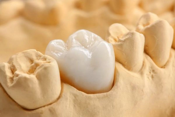 Răng sứ titan là một trong những loại răng sứ được ưa chuộng trong việc phục hình thẩm mỹ nha khoa hiện nay