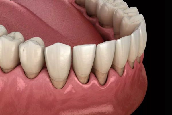 Răng mắc bệnh lý nghiêm trọng, chân răng quá yếu nếu bọc sứ sẽ không thể đảm bảo tuổi thọ lâu dài mà còn có thể ảnh hưởng tới khả năng ăn nhai