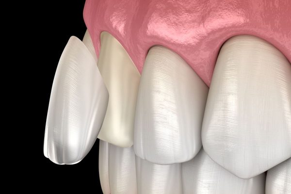Mặt dán sứ veneer được gắn trực tiếp lên răng thật sau khi đã mài mỏng khoảng 0,3 - 0,5 mm