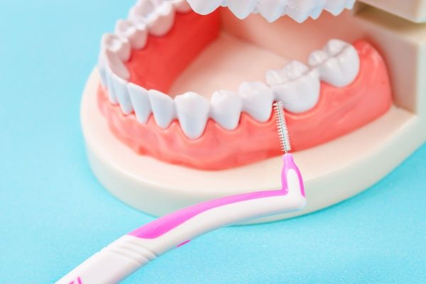 chăm sóc răng sau khi niềng răng