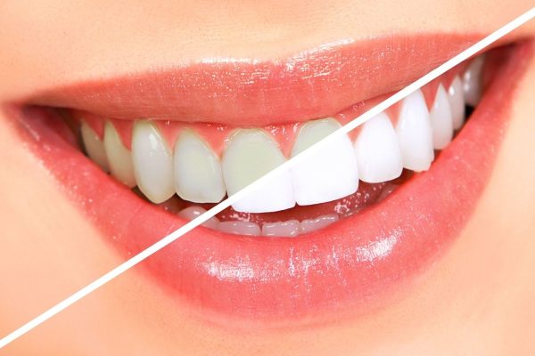Dán sứ veneer có bền không còn tùy thuộc vào chất liệu mặt dán sứ, tình trạng sức khỏe răng miệng, cách chăm sóc hằng ngày...