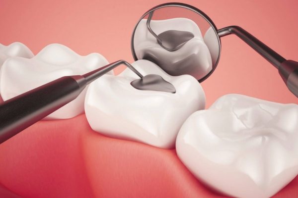 Điều trị tủy răng số 7 bằng việc hút tủy viêm và hàn kín ống tủy