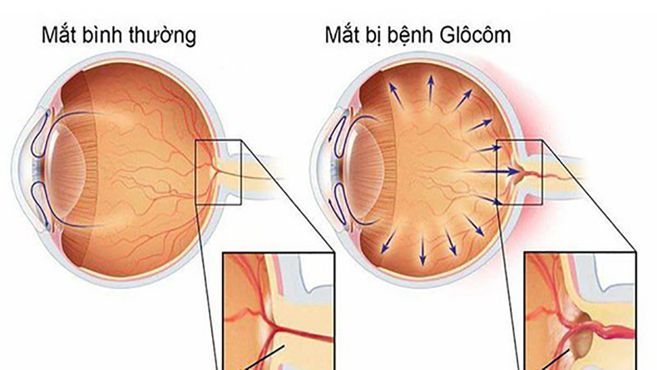Hình ảnh bệnh nhân bị glocom góc mở gây suy giảm thị lực ngoại vi và nhìn mờ dần