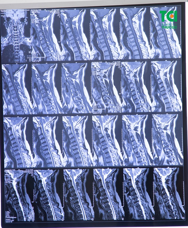 chẩn đoán thoái hóa đốt sống cổ bằng chụp cộng hưởng từ MRI