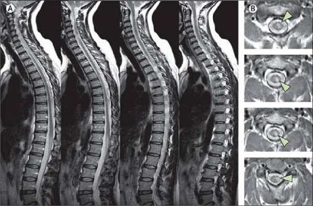 chụp mri cột sống