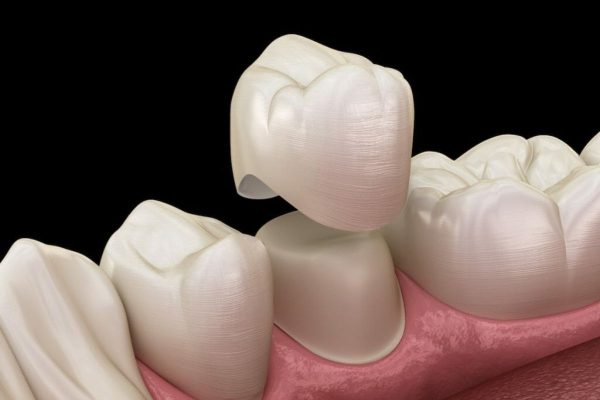Bọc răng sứ là kỹ thuật gắn mão sứ chất lượng cao lên bề mặt răng thật đã được mài với một kích thước rất nhỏ