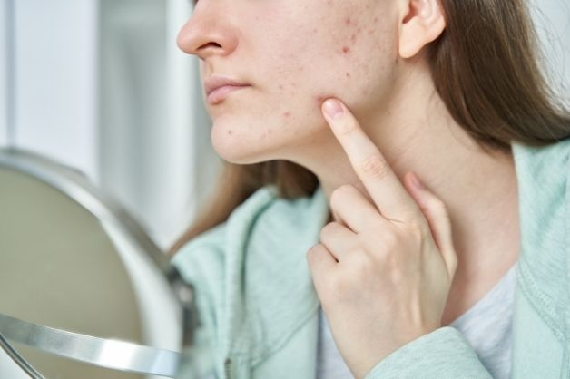 Dễ nổi mụn là một trong những nguy cơ xuất hiện do mất ngủ ở tuổi dậy thì