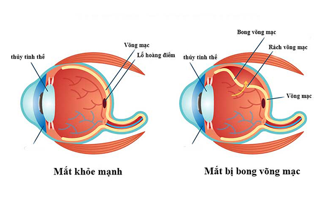 Rách võng mạc