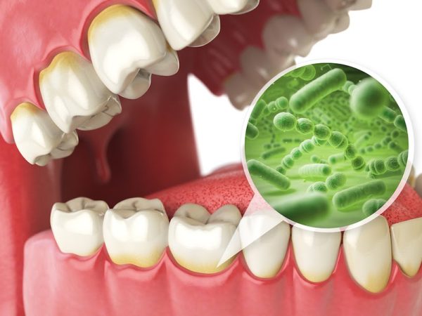 Răng sâu có tẩy trắng được không?