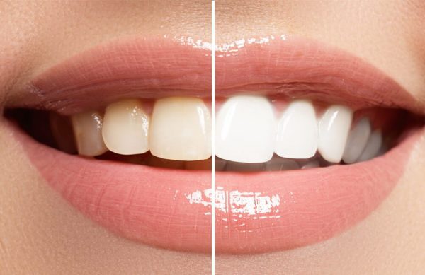 Tẩy trắng răng được xem như phương pháp cứu cánh thần kỳ cho hàm răng ố vàng, xỉn màu