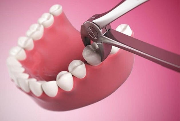 Sâu răng có phải nhổ không?
