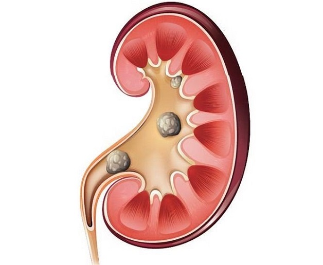 Sỏi thận bàng quang thường do sỏi thận rơi xuống
