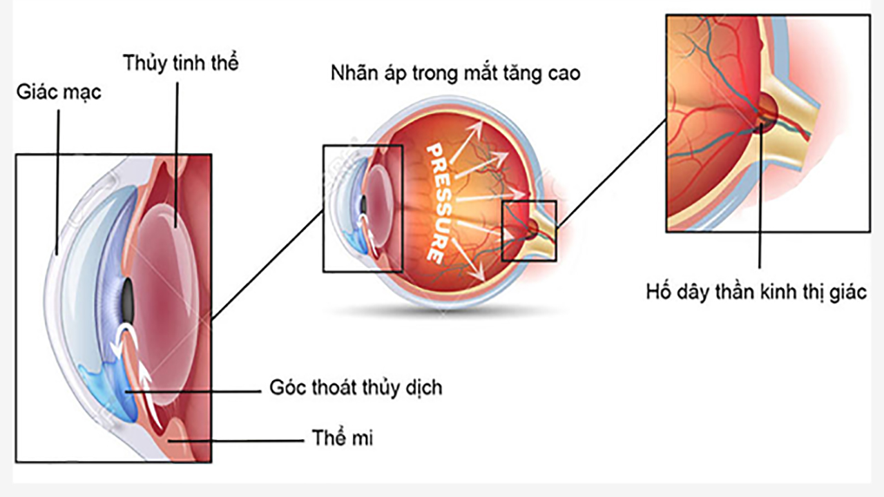 Hình ảnh mô tả nguyên nhân tăng nhãn áp do tắc nghẽn dòng chảy thủy dịch trong mắt