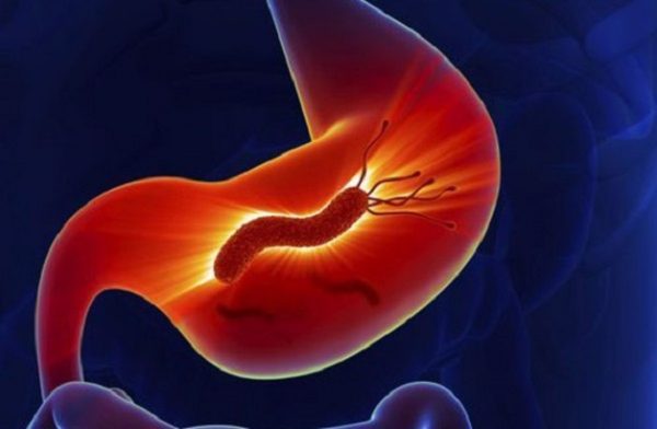 Cách chữa viêm loét hành tá tràng gây ra bởi vi khuẩn HP