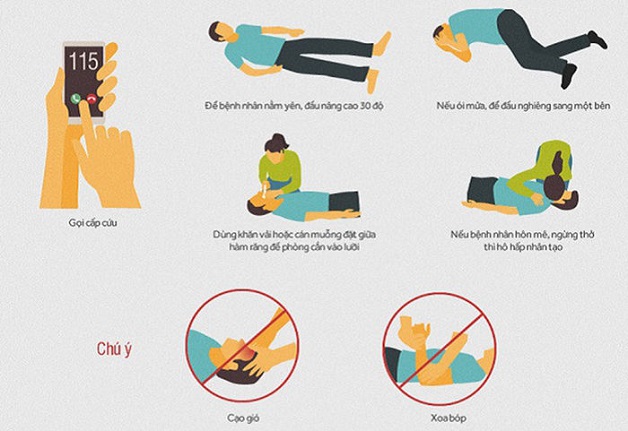 Cách xử trí khi thấy có người bị tai biến mạch máu não