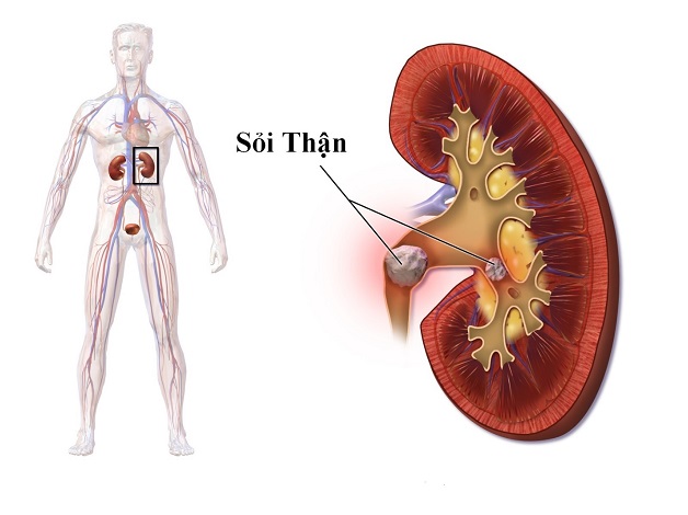 Chế độ dinh dưỡng không phù hợp có thể gây ra sỏi