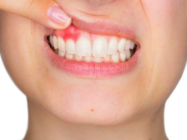 Viêm lợi có thể gặp ở nhiều lứa tuổi