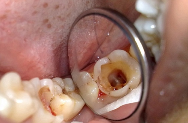 Sâu răng là hiện tượng tổn thương vĩnh viễn ở bề mặt răng