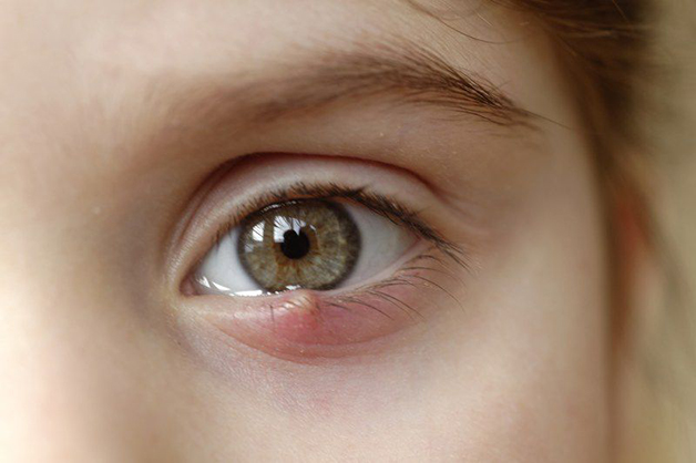 Cách trị lẹo mắt