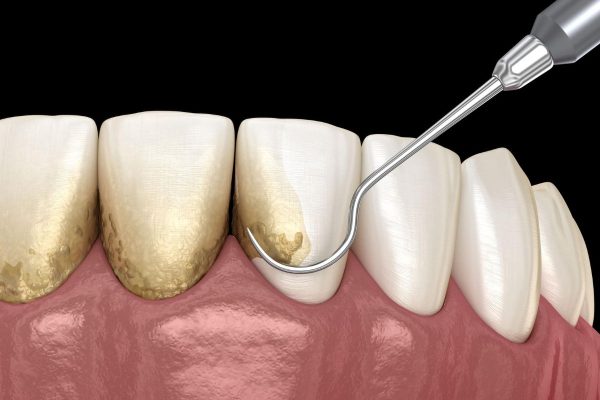 Cao răng là mảng bám tích tụ bị vôi hóa ở thân răng và dưới mép lợi, gây mất thẩm mỹ và khiến răng dễ mắc bệnh lý