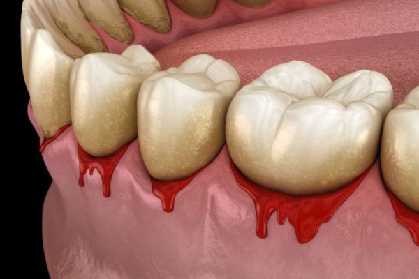 Cao răng thường bám chắc vào bề mặt răng hoặc dưới mép lợi, gây ra nhiều bệnh lý nguy hiểm