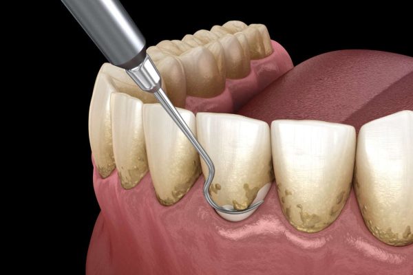 Có nên lấy cao răng không, câu trả lời là có, để bảo vệ sức khỏe răng miệng