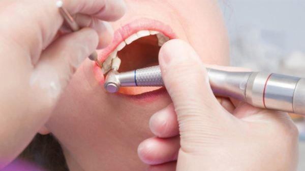 Có nên lấy cao răng thường xuyên không?