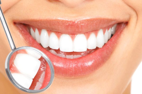 Tuổi thọ của dán sứ veneer được bao lâu còn tuỳ thuộc vào rất nhiều yếu tố