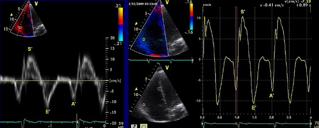 khi nào cần siêu âm doppler tim