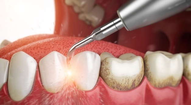 Cao răng là mảng bám có màu vàng hoặc màu nâu hình thành ở bên dưới nướu hoặc ở cổ răng.