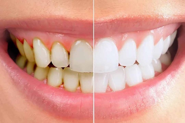 Lấy cao răng có trắng răng hay không?