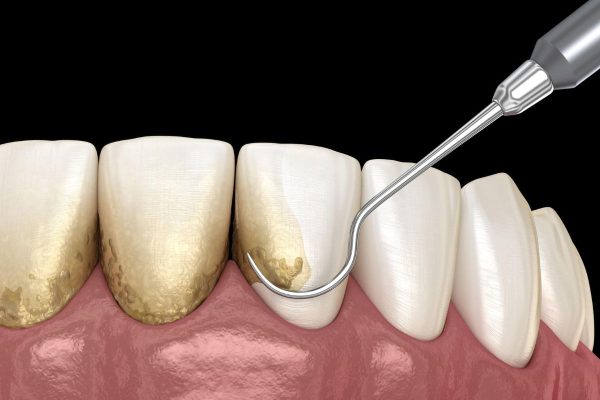 Cao răng là tác nhân gây ra một số bệnh lý nha khoa nên cần được loại bỏ thường xuyên