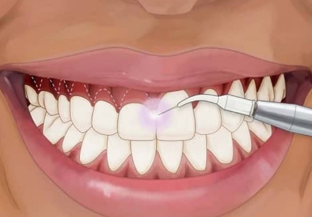 Phẫu thuật cắt lợi có nguy hiểm không?