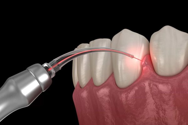 Với những trường hợp hở lợi 3mm, bác sĩ sẽ chỉ định phẫu thuật hở lợi bằng việc cắt viền nướu kết hợp làm dài thân răng
