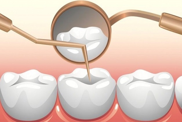 Trám răng bằng Composite là giải pháp phục hình thẩm mỹ được nhiều khách hàng lựa chọn