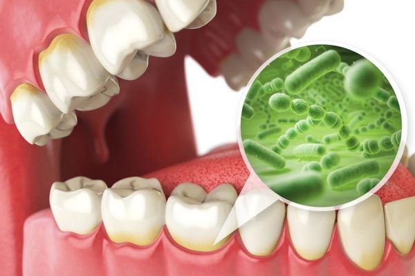 Vi khuẩn hình thành từ cao răng, mảng bám tấn công tới các tổ chức răng và gây sâu răng