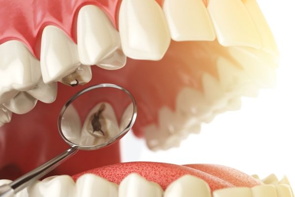 Sâu răng có thể gặp ở bất cứ lứa tuổi nào
