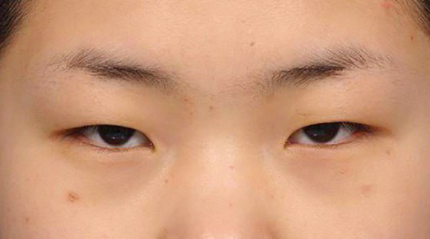 Sụp mí mắt
