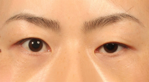 Sụp mí mắt