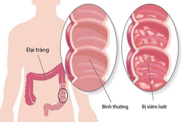 viêm đại tràng và mắc viêm đại tràng nên ăn gì
