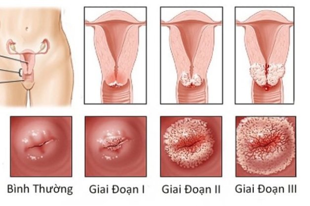 ung thư cổ tử cung là gì