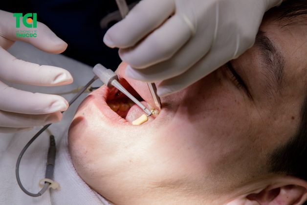 Sâu răng vào tủy chỉ có thể được điều trị bằng phương pháp diệt tủy