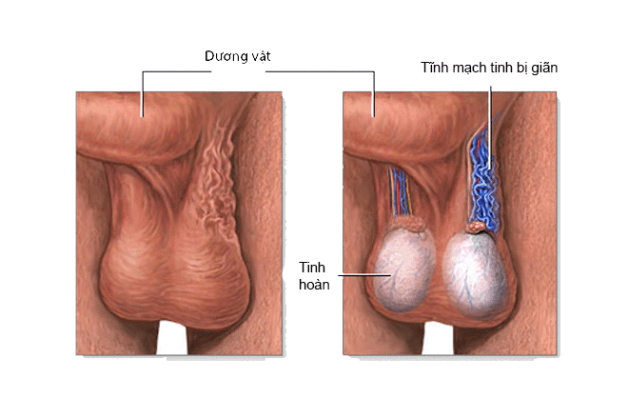 Giãn tĩnh mạch thừng tinh là gì?
