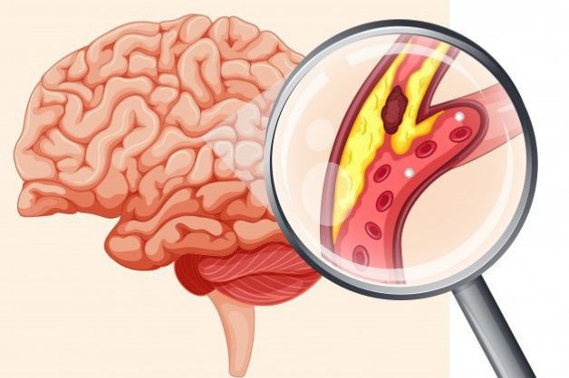 Nhồi máu não là một biến cố nguy hiểm