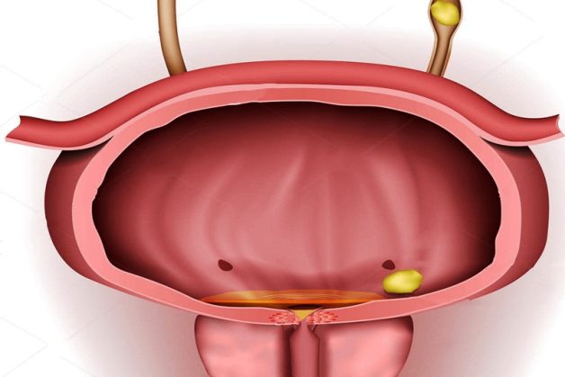 bệnh sỏi bàng quang có nguy hiểm không 