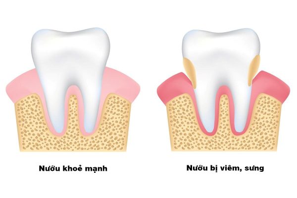 bệnh viêm nướu