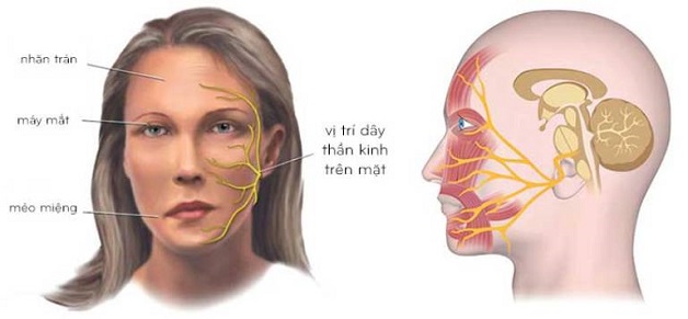 Viêm dây thần kinh số 7 là bệnh gì?