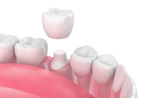 Bọc răng sứ là kỹ thuật phục hình bằng việc chụp mão sứ lên trên cùi răng thật để khắc phục các khiếm khuyết răng miệng